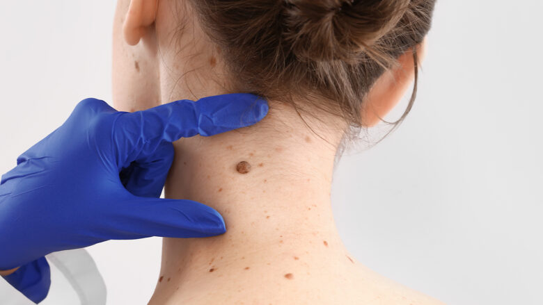 A duhet të hiqet lythi? Shenjat që kërkojnë ekzaminim urgjent dermatologjik