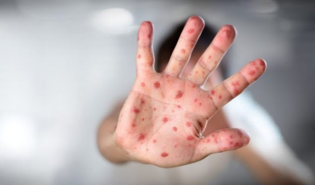 Tetë raste të fruthit në Kosovë, IKSHPK: Të gjithë të infektuarit të pavaksinuar